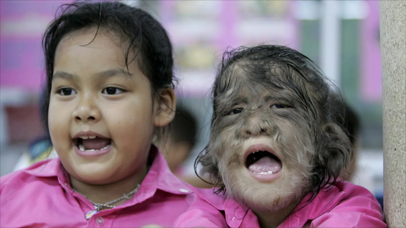 متلازمة المستذئب وراء حالة فريدة لطفل فلبيني يثير الاستغراب