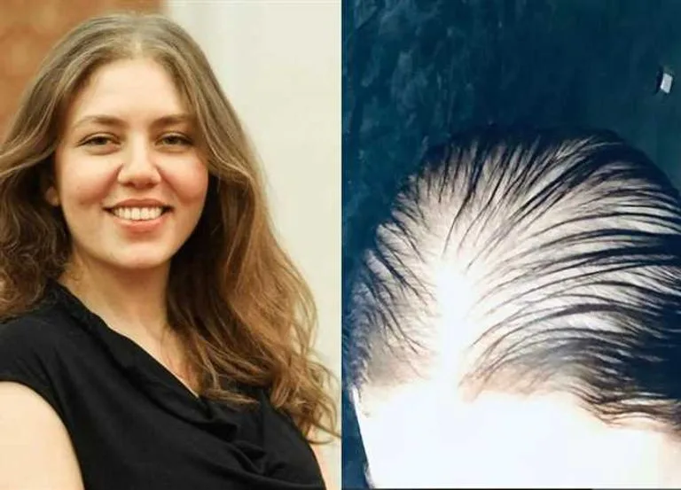 رحمة حسن تتصدر التريند وتكشف عن "خطأ طبي جسيم": شعري تساقط بالكامل رحمة حسن