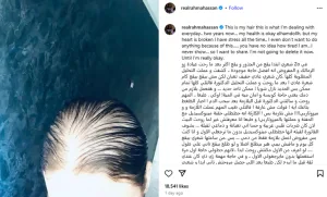 بعد إصابة الفنانة رحمة حسن بالصلع.. تعرف على أسبابه وعلاجه رحمة حسن